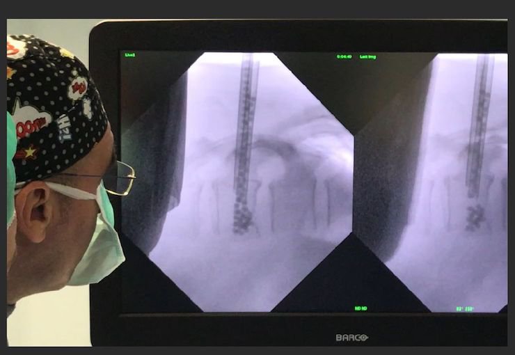 Kyphoplasty procedure.