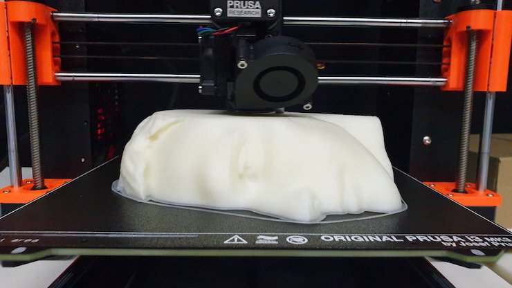 Facial nerve paralysis