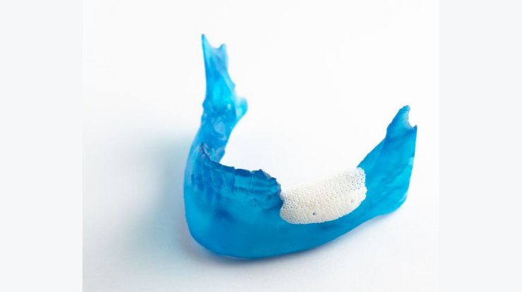 Example of MyBone 3D printed implant
