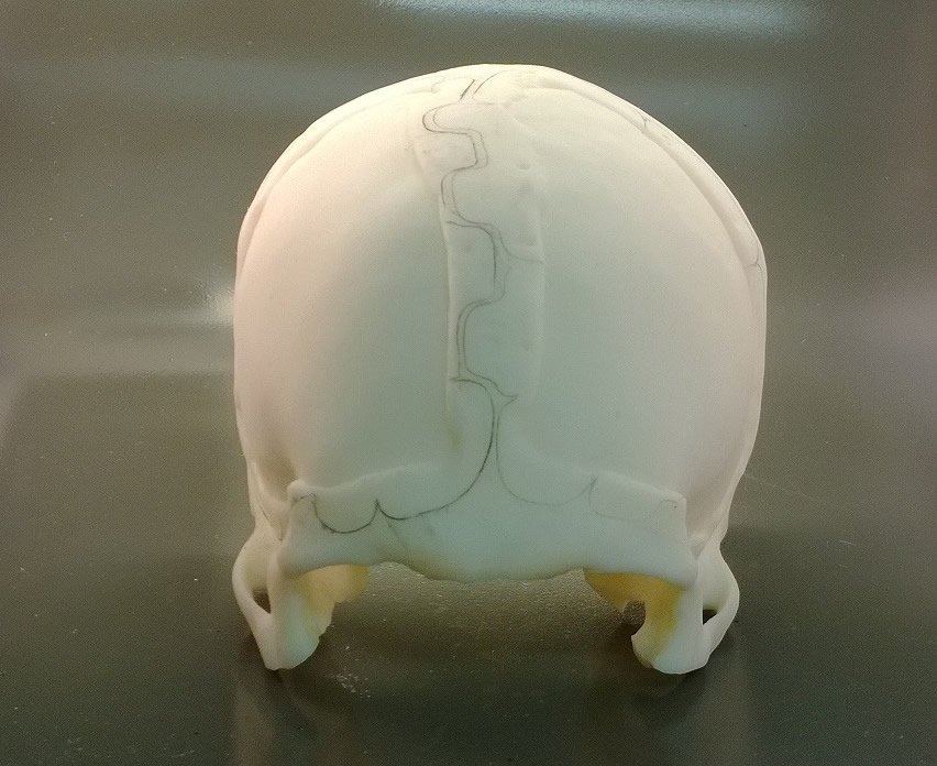 Cranioplasty without implant