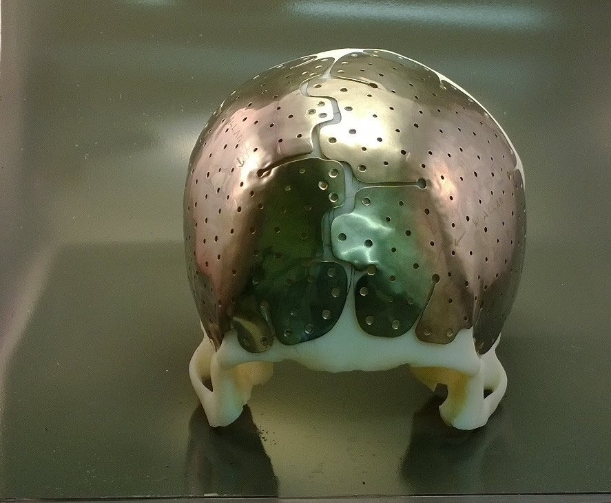 Cranioplasty with implant