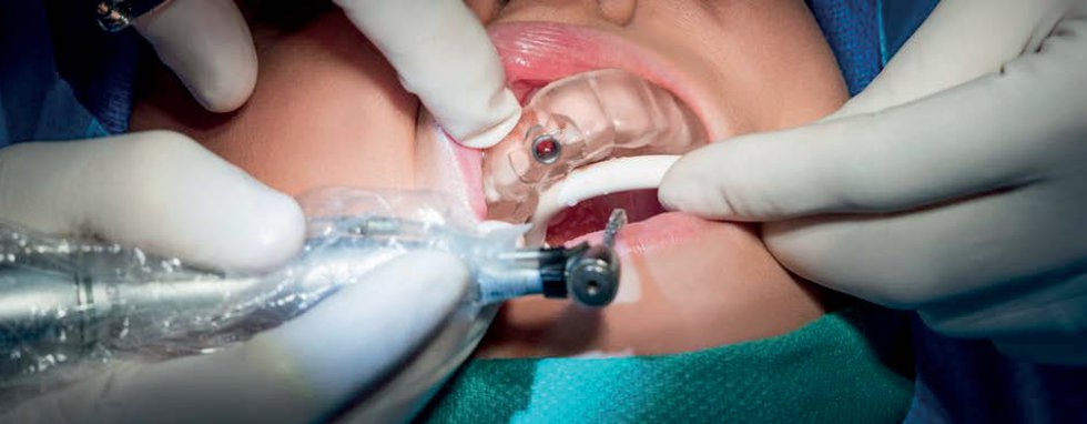 Formlabs’ dental surgical guide in surgery