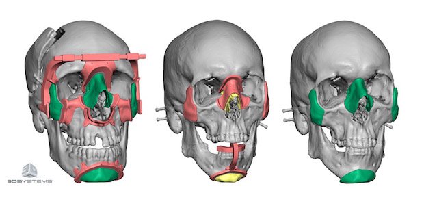 3D Systems cranial surgery