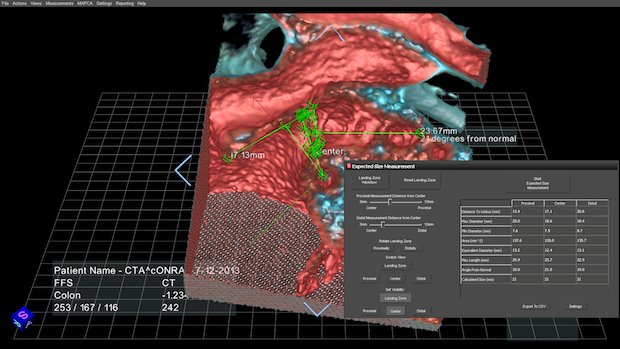 EchoPixel software medical