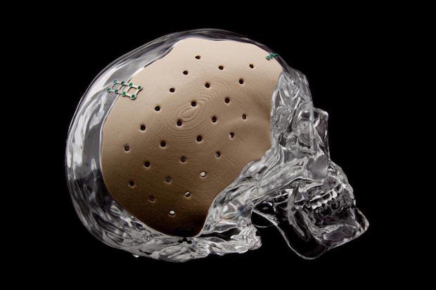 OPM OsteoFab cranial device