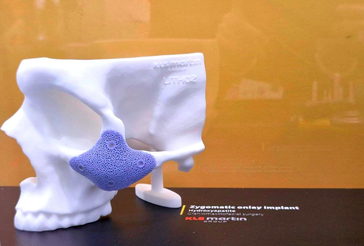 Application spotlight: Ceramic 3D printing enables patient-specific zygomatic onlay implants