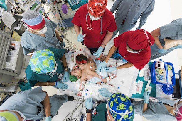 Conjoined twins separated with help of 3D printed model