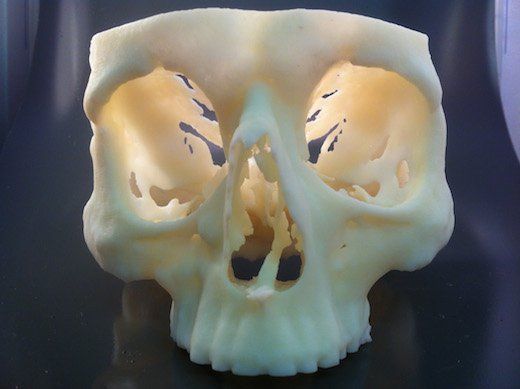 Cranium produced on a Stratasys Objet30 Pro 3D Printer,  used to validate patient surgery prior to the operation.