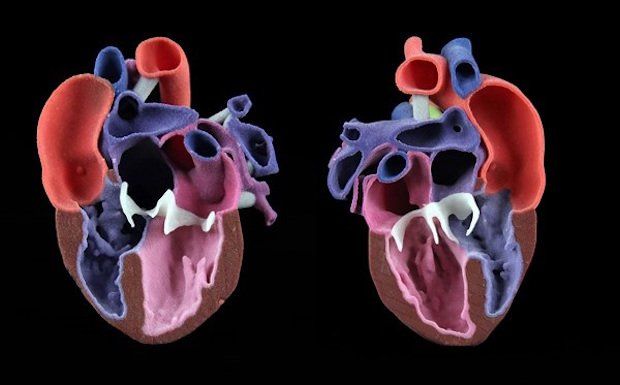 3D heart model with congenial abnormalities      3D heart model with congenial abnormalities - 3D Systems