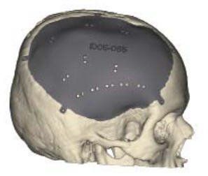 Craniomaxillofacial implant.