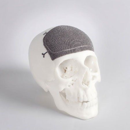 Custom Cranio-Maxillofacial implant from Arcam.