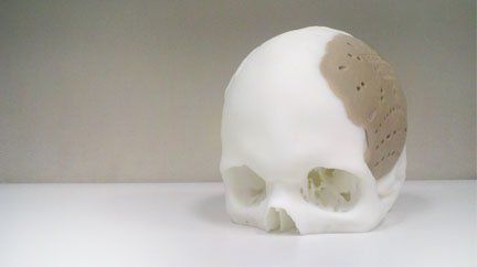 OPM to research infections related to 3D printed medical implants.