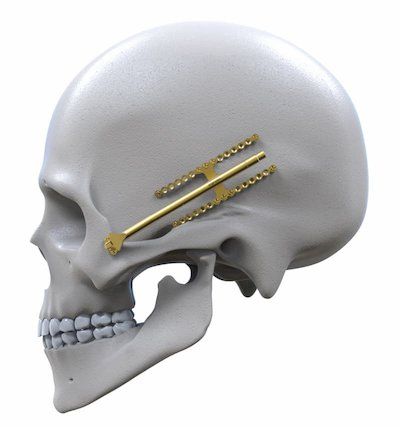 Engimplan-implant - Engimplan/ Materialise