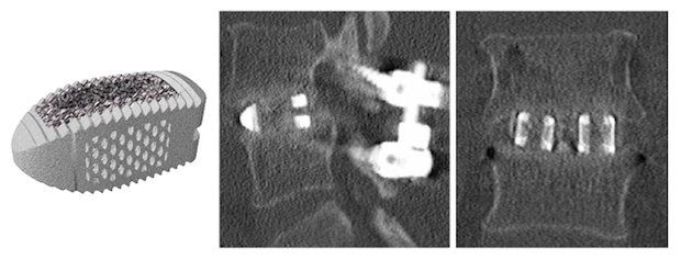 Mimetic Metal combines a lattice framework and inner trabecular pores to emulate the properties of bone.