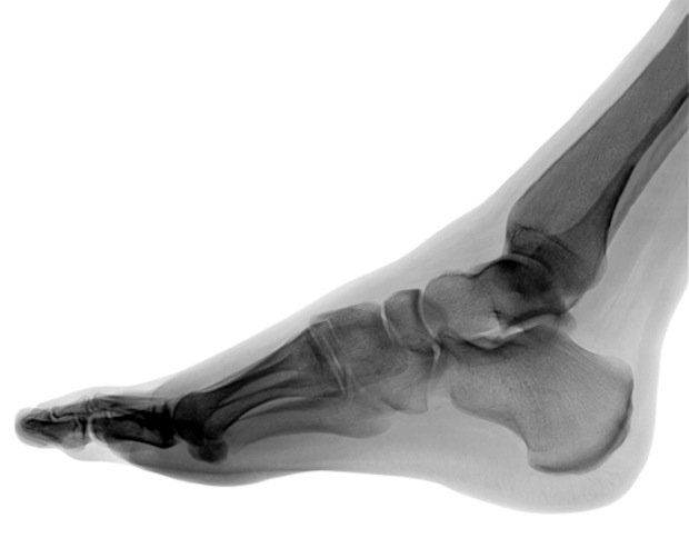 Foot X-ray - By Hamelin de Guettelet, via Wikimedia Commons