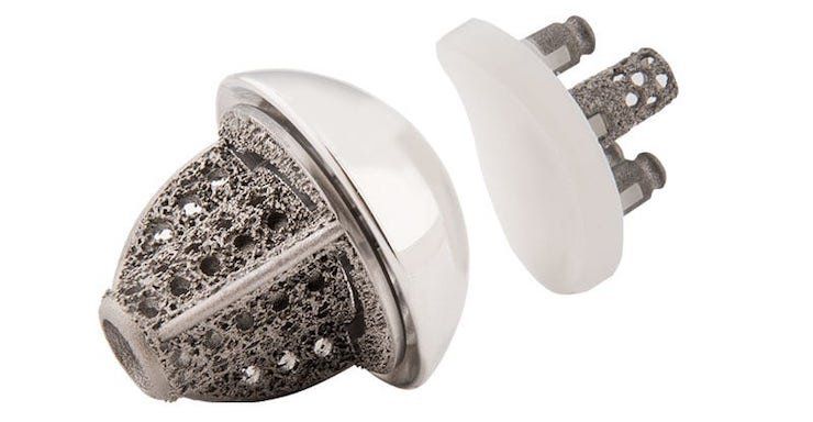 Exactech's Stemless Shoulder implant.      Exactech's Stemless Shoulder implant. - Exactech