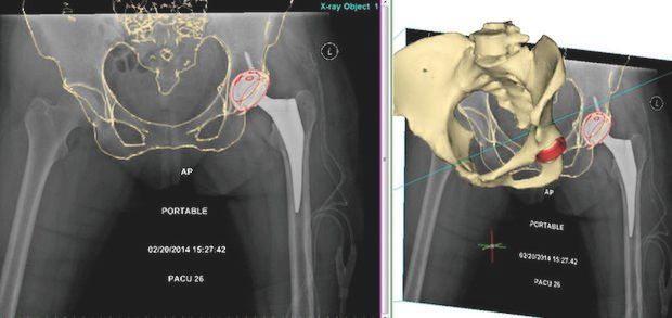 X-ray and pre-op CT scan from Hospital for Special Surgery, New York. - Materialise Medical Blog.