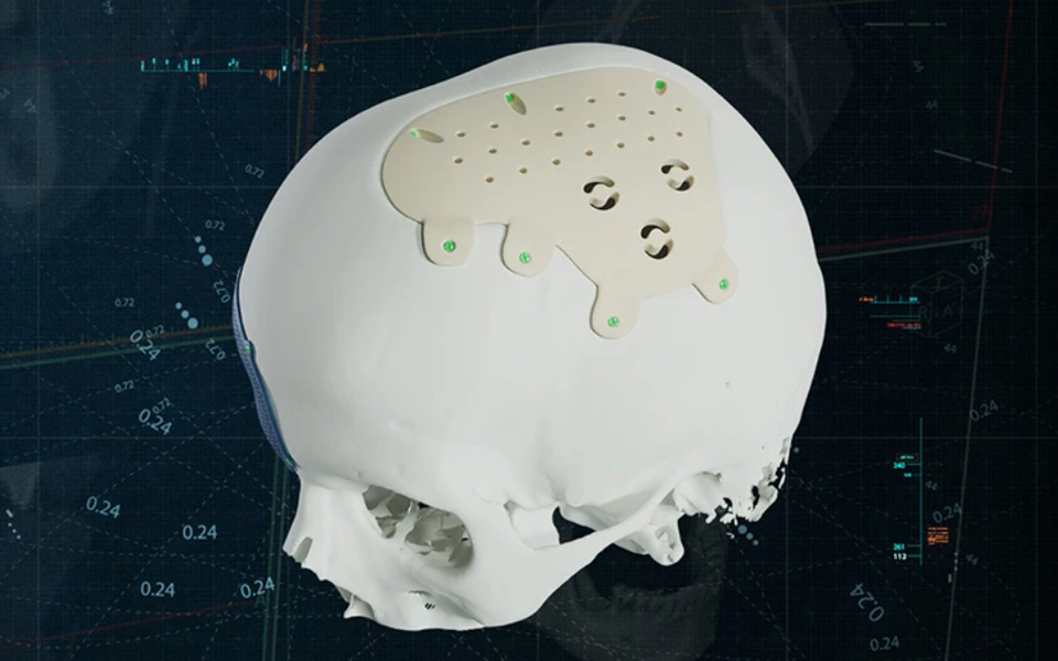 Materialise adds PEEK to cranio-maxillofacial implant options