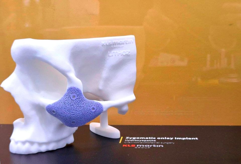 Application spotlight: Ceramic 3D printing enables patient-specific zygomatic onlay implants