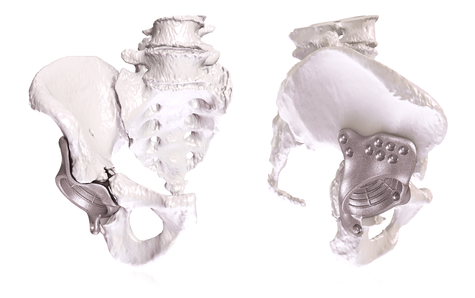 Onkos Surgical celebrates 1,000th patient-specific pelvic implant case