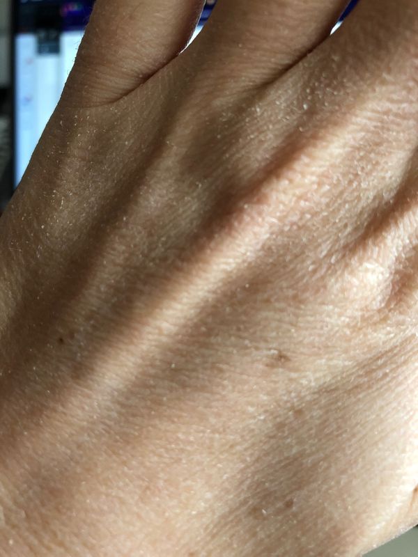 Dry skin in the winter