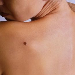 Melanoma Survival Rates Lag Behind Other Types of Cancer