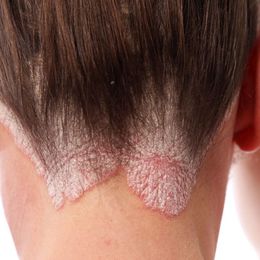Psoriasis Sufferers: Keep an Eye on Blood Sugar!