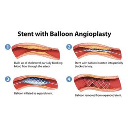 'Cardio-Cocktail' a Good Substitute for Angioplasty
