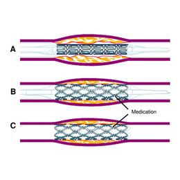Study: Drug-Coated Stents Better than Angioplasty