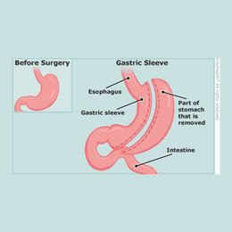 Is Weight-Loss Surgery For You?