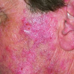 New Lupus Medication Surpasses Expectations