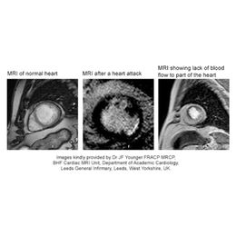 Computer Helps MRI Measure Heart Damage