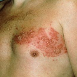 Why It's So Important to Prevent Shingles Now