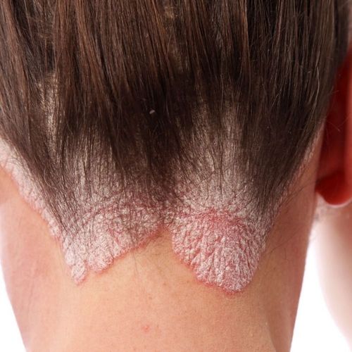 Psoriasis Sufferers: Keep an Eye on Blood Sugar!