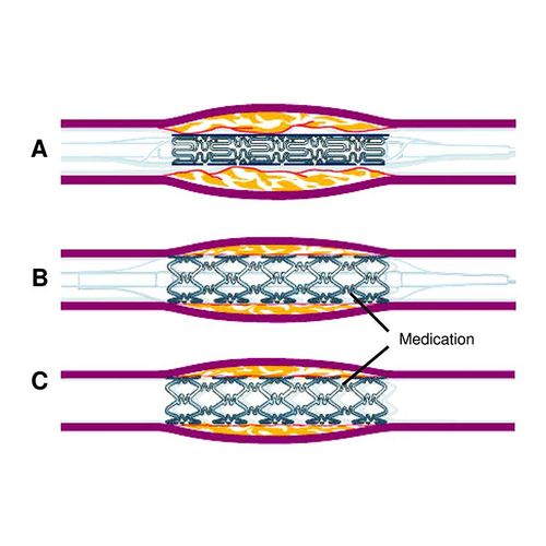 Study: Drug-Coated Stents Better than Angioplasty