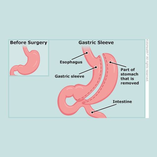 Is Weight-Loss Surgery For You?