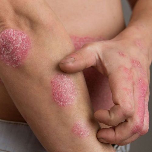 Drug Clears Psoriasis in Up to 80% of Patients