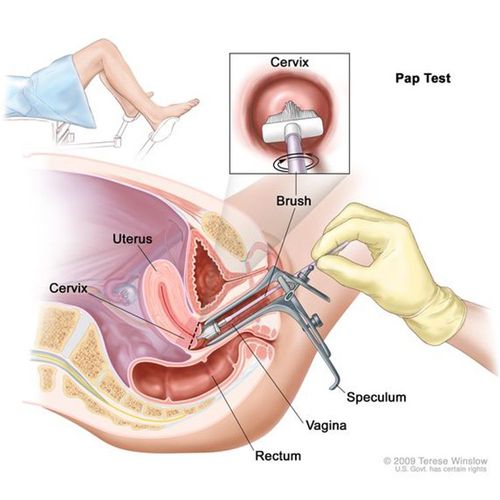 Why Women Are Not Getting Lifesaving Pap Test