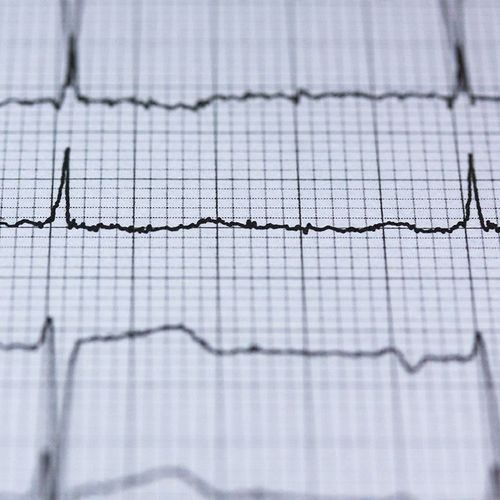 Cutting-Edge Cure for Irregular Heartbeat