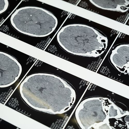 Are You Headed For a Stroke?