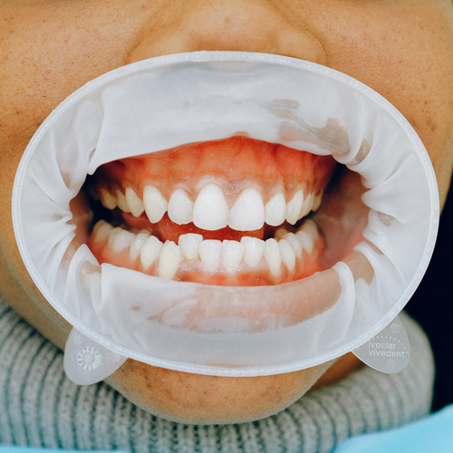 Popular Osteoporosis Drugs May Cause Jaw Problems