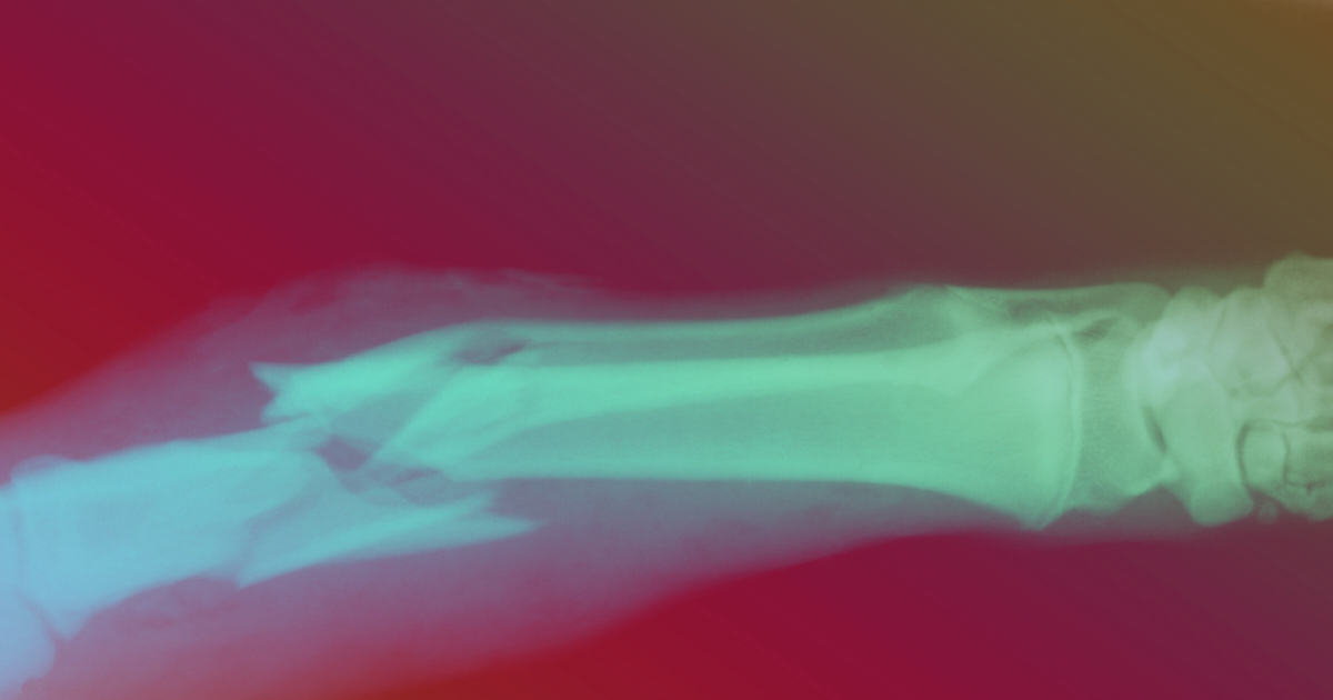 Fractures, nouveautés pis être célibataire