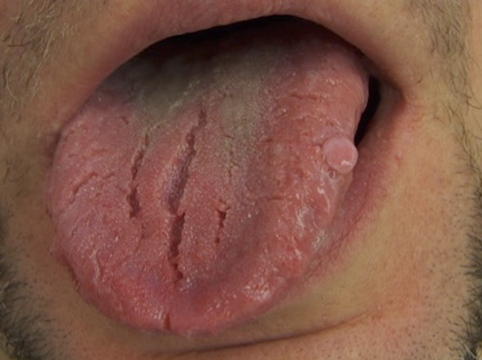 Reactive lesion on the lateral side of the tongue – benign mucosal change