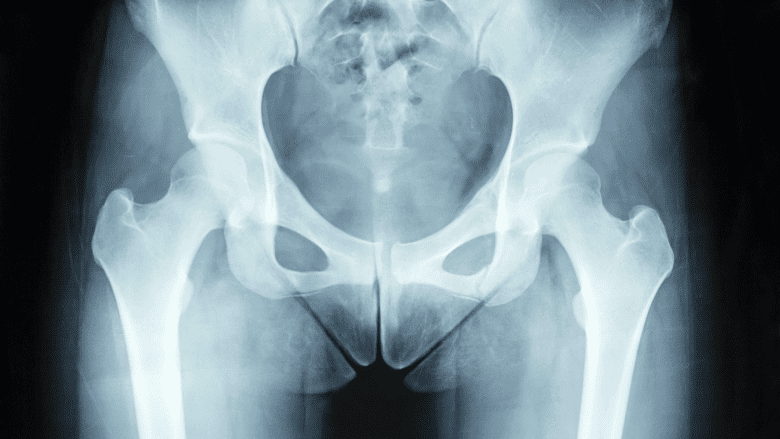 A groin is a terrible thing to strain