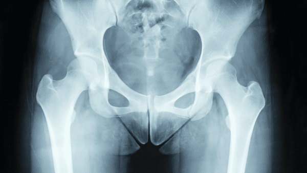 A groin is a terrible thing to strain