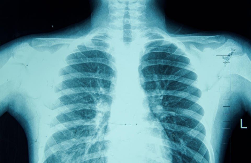 Human Thoracic cavity X-ray Film