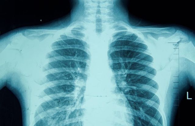 Deepfake X-Rays Fool Radiologists In New Study—AI Has Turned Medical Fraud Into A Volume Problem