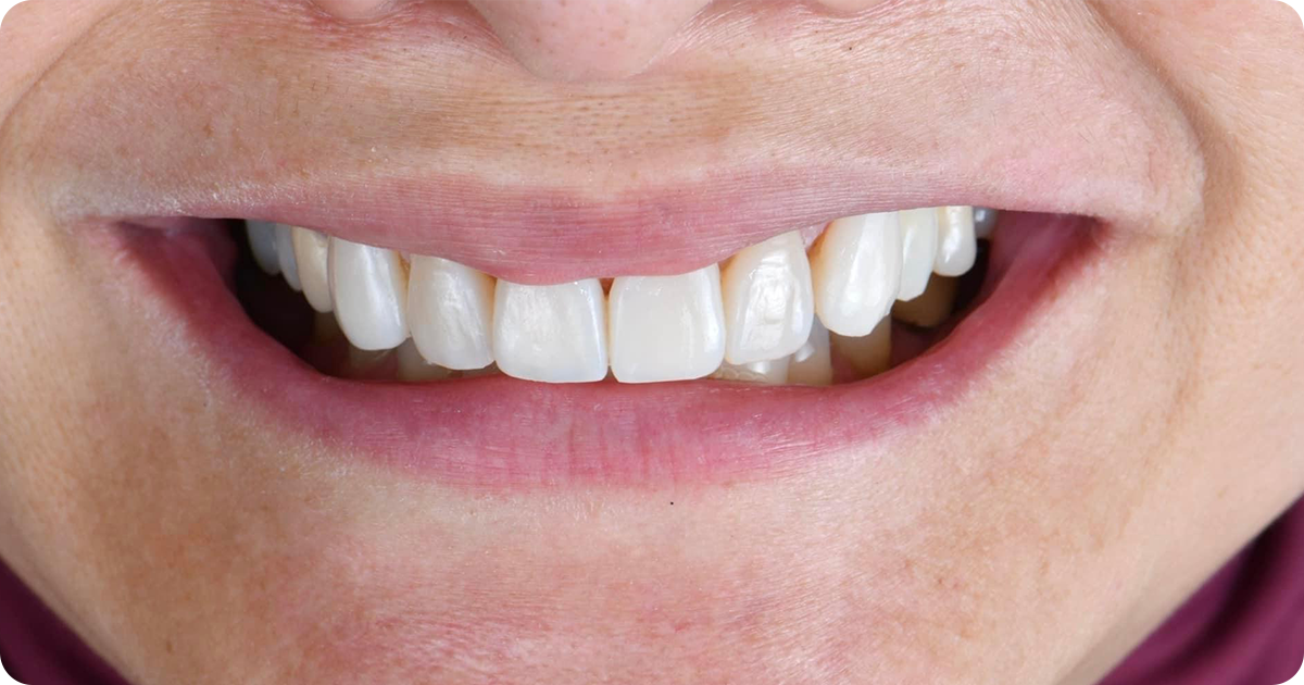 A clinical case of Amber Mill veneer by Dr. Puay Parinya, showcasing natural esthetics.