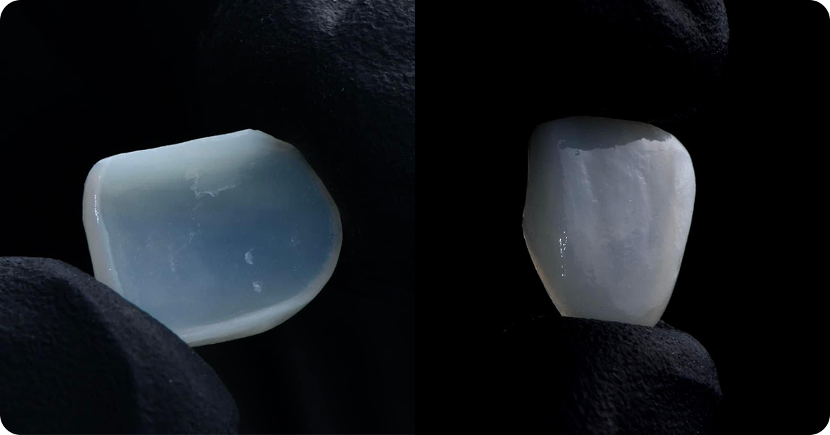 A professional clinical image of Amber Mill veneer, presented by Puay Parinya. 