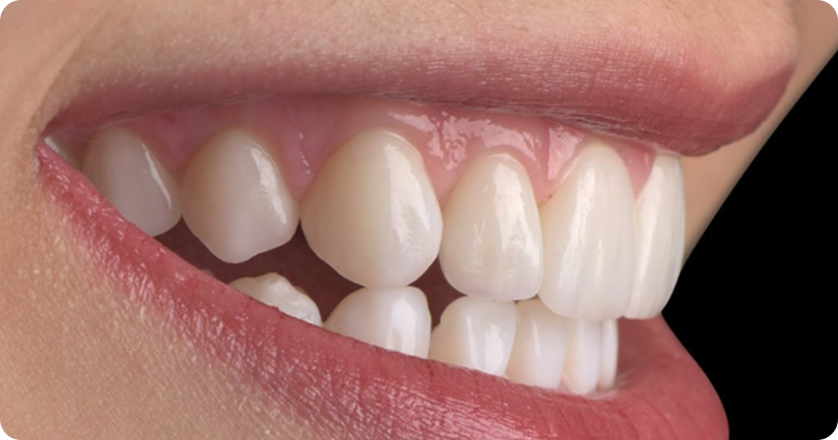 What to Know Before Getting Permanent Veneers: Pros, Cons & Lifespan